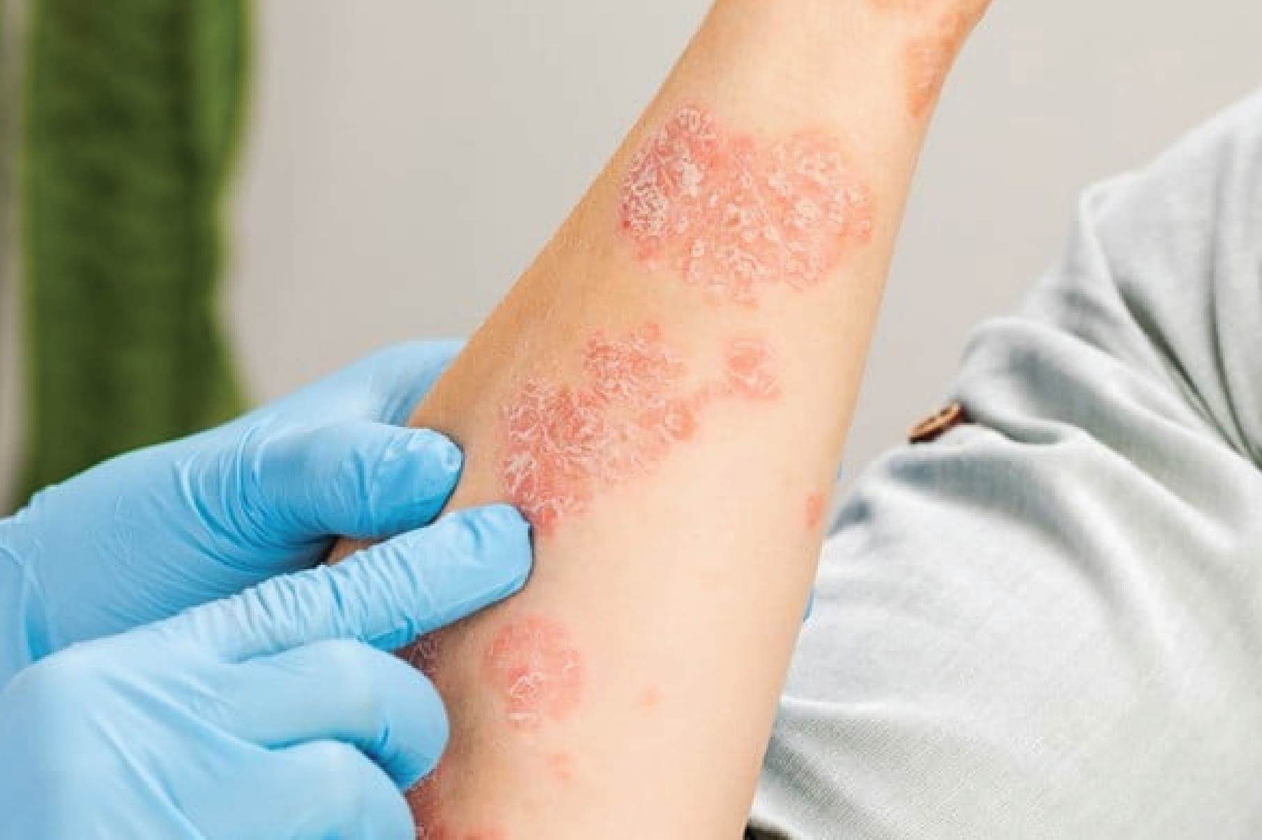Allergy Treatment
